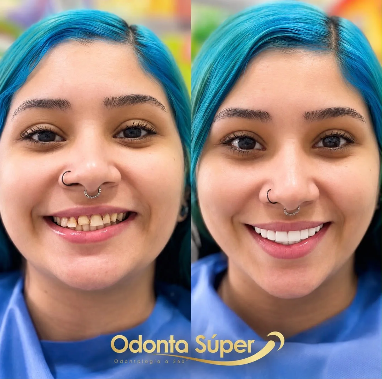 Real patient before and after result from a Colombia Smile Studio consultation.