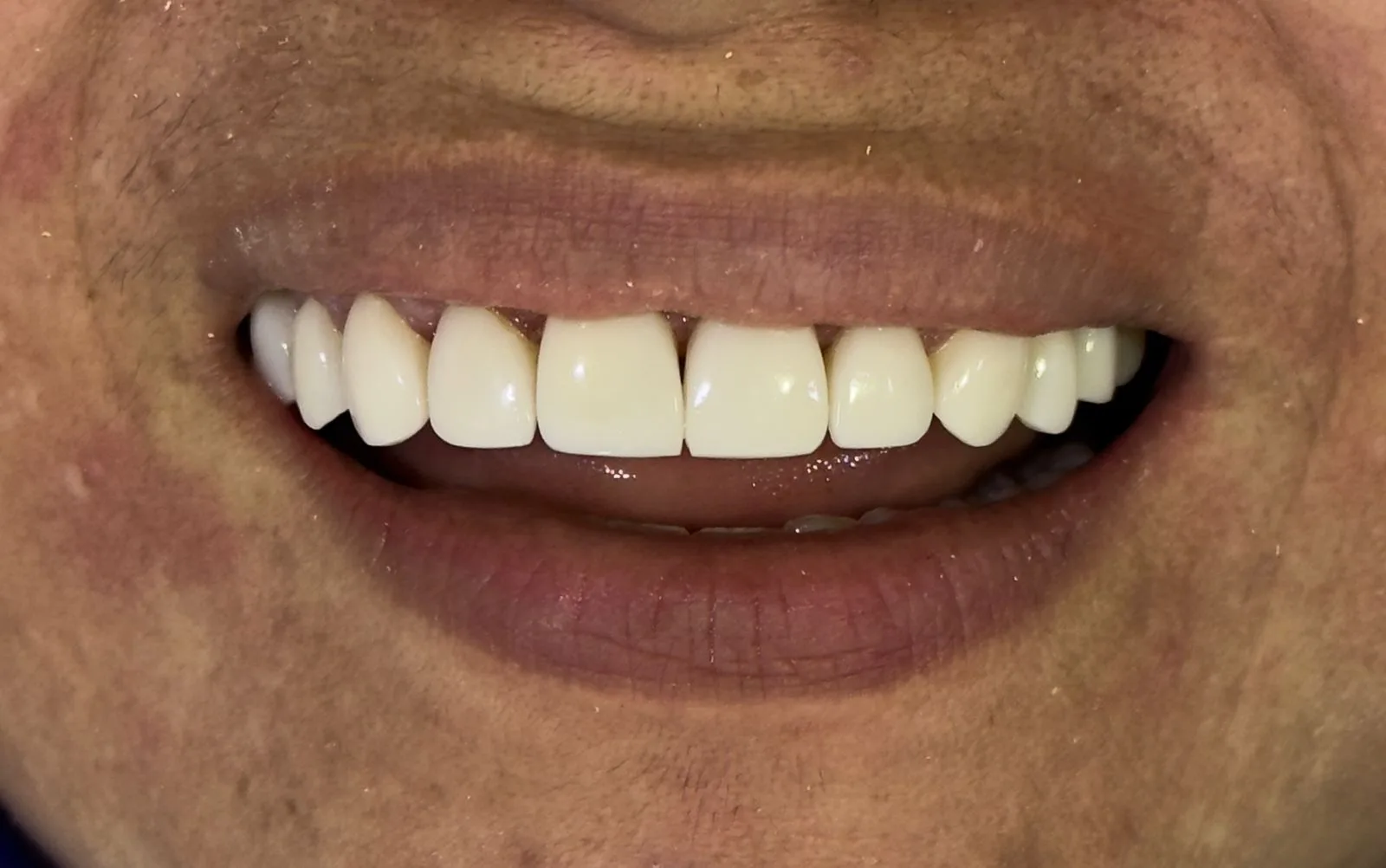 Real patient veneer smile result from the Medellin clinic.