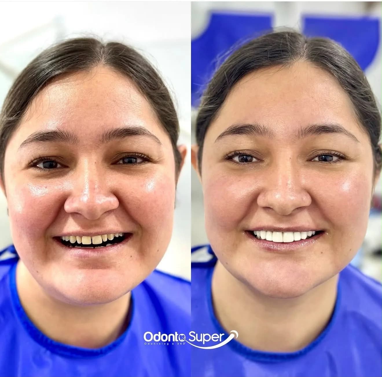 Real patient before and after porcelain veneer candidacy review and treatment.