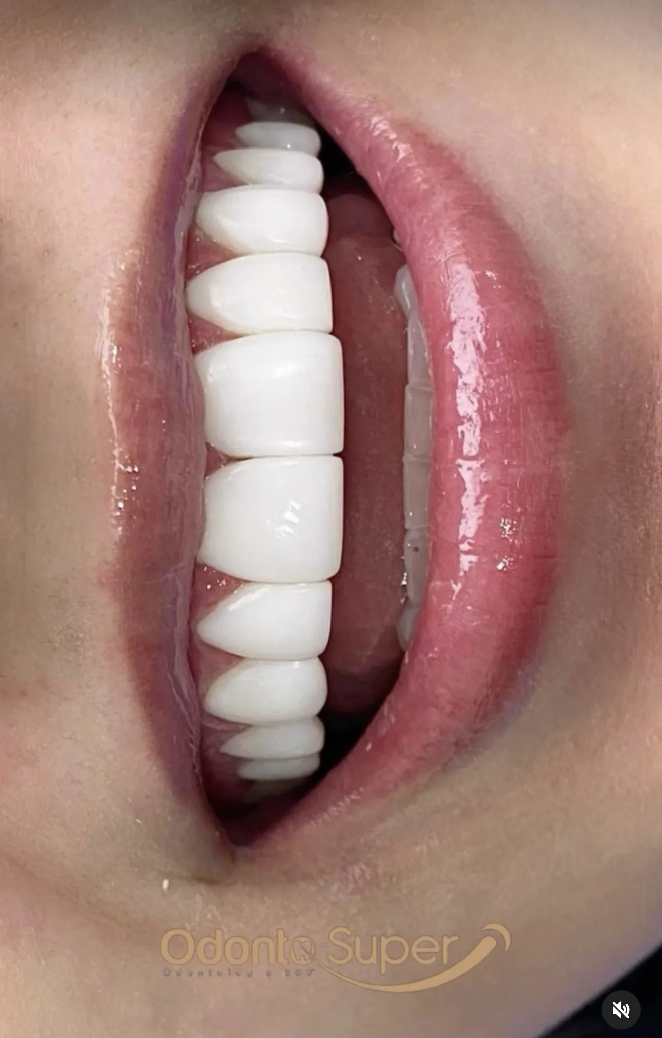 Fine layered porcelain veneer detail on a real patient case.