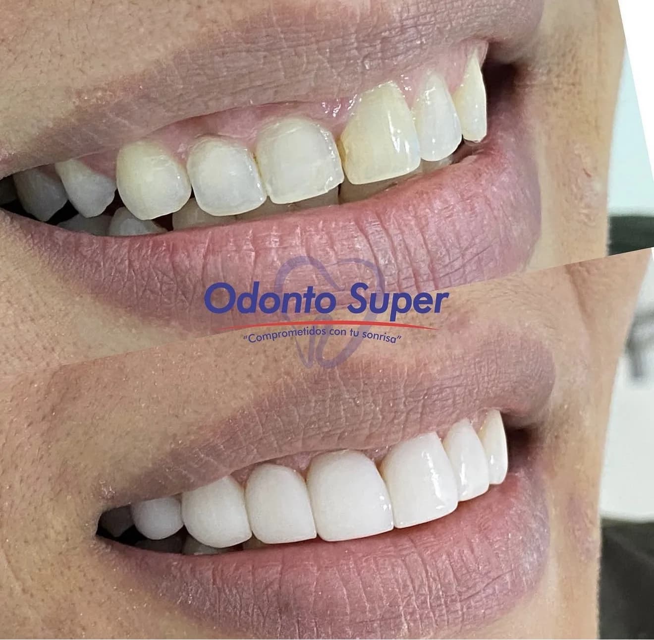 Real patient smile before and after porcelain veneers at the Medellin clinic.