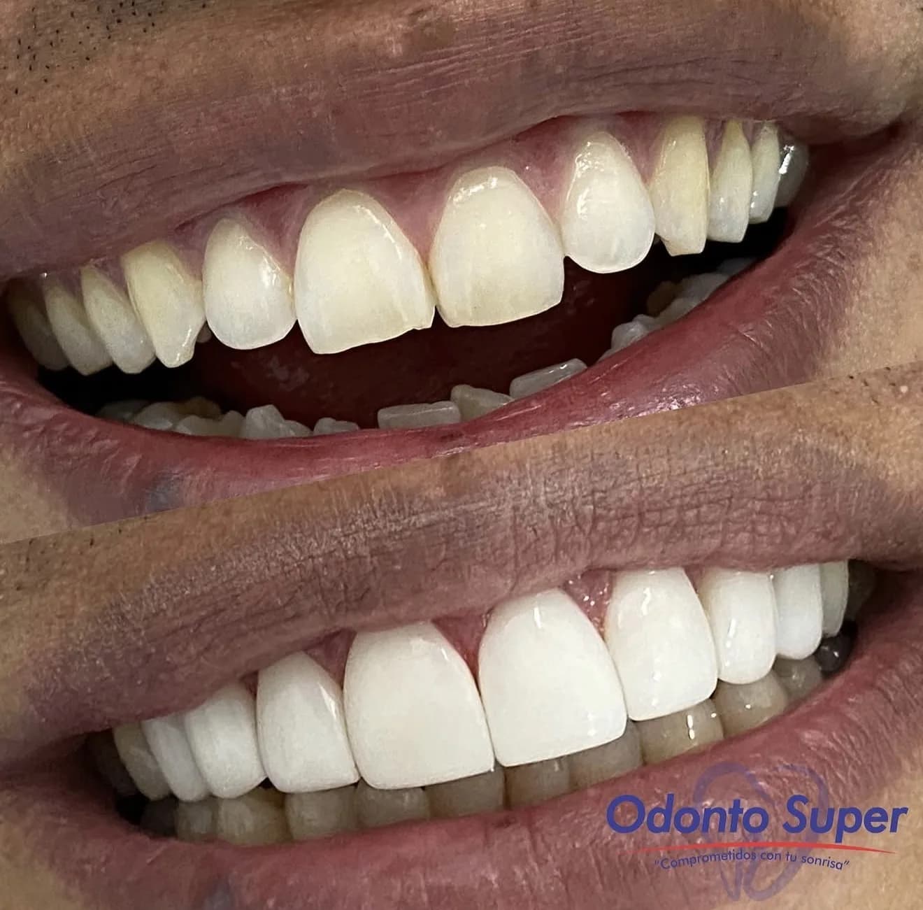 Lifelike enamel translucency on a real finished veneer smile.