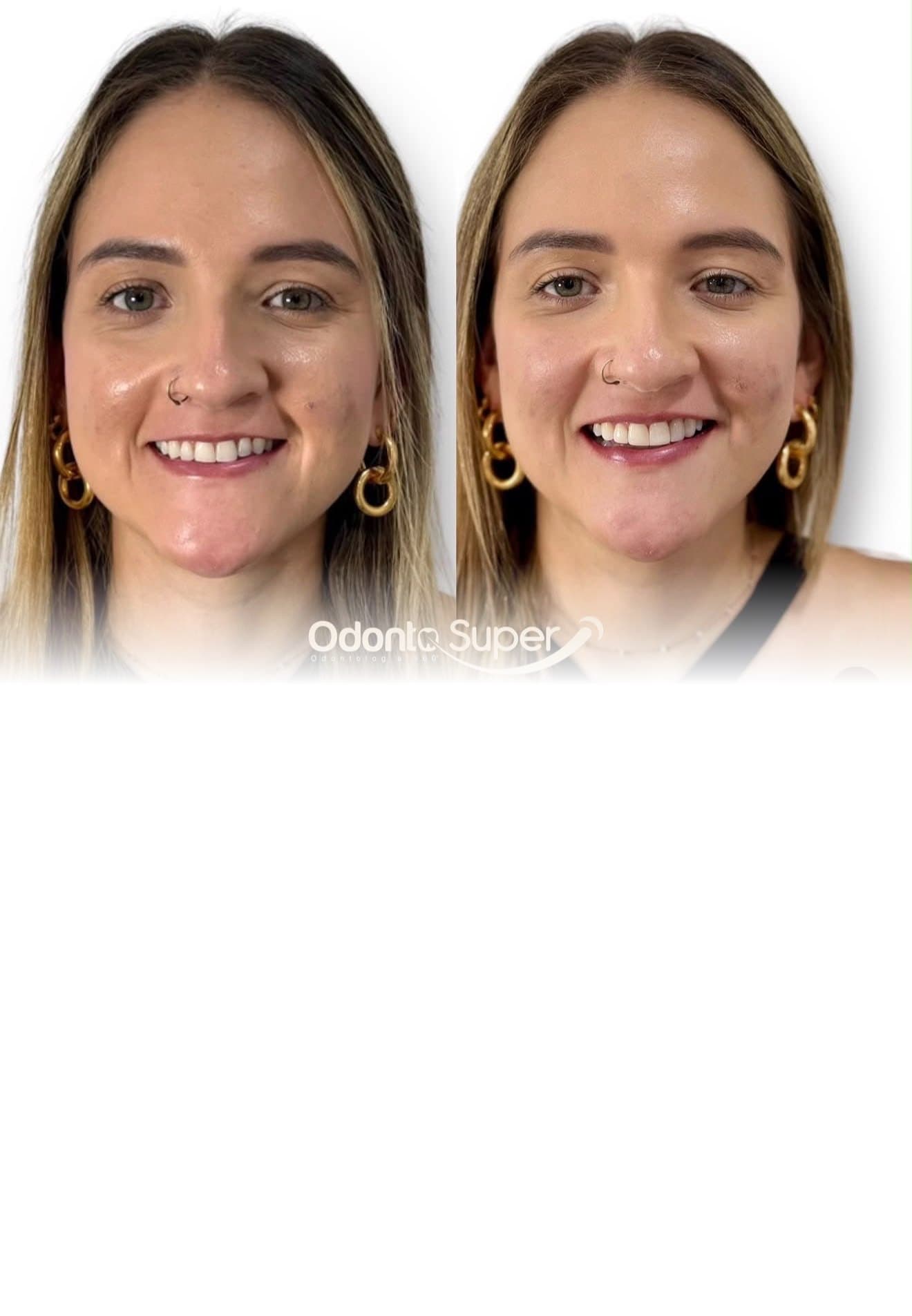 Before and after veneer transformation on a real patient at the Medellin clinic