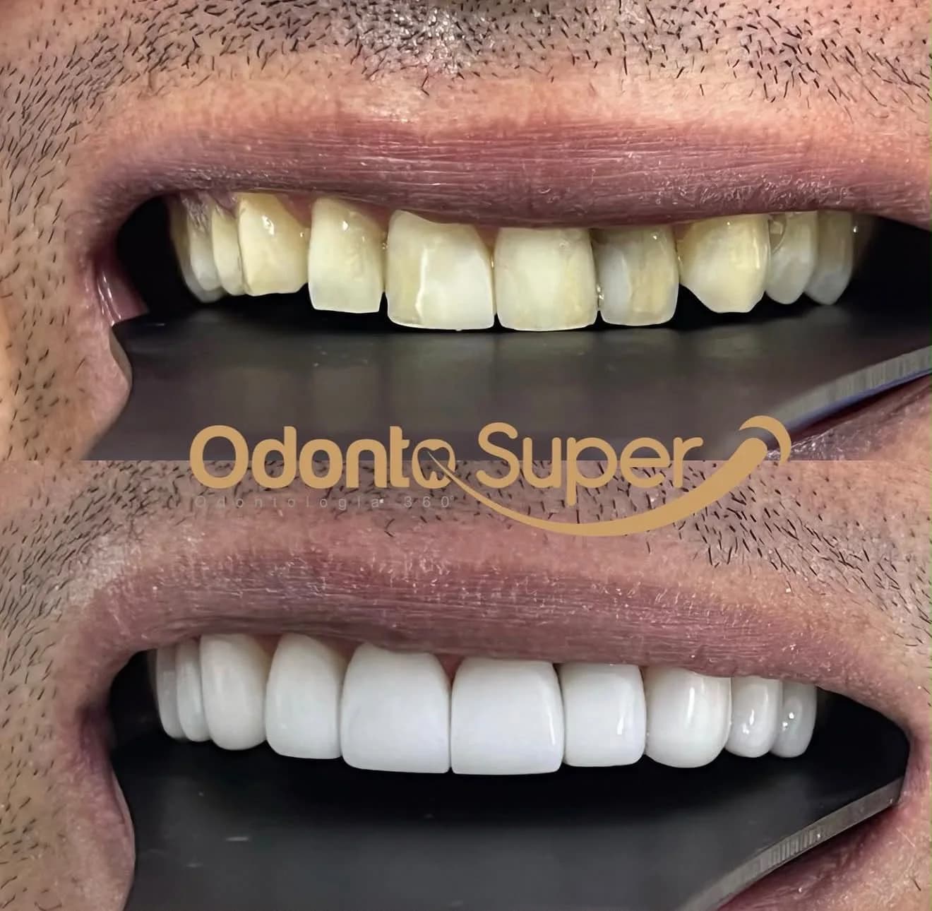 Real before and after showing brightness and smile balance changes.