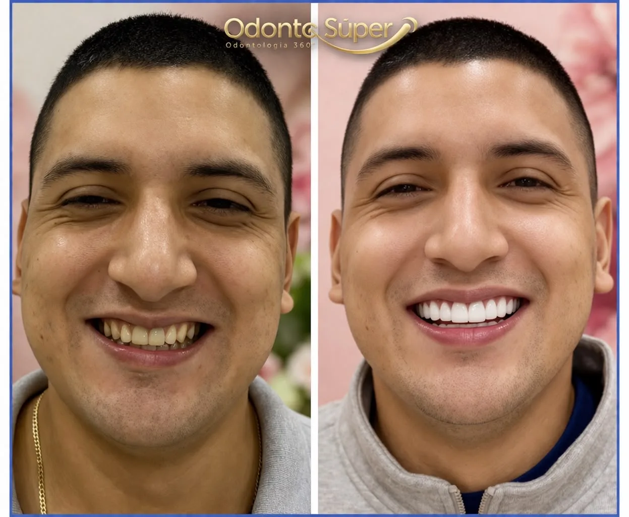 Real patient smiling after finishing veneer treatment at the clinic